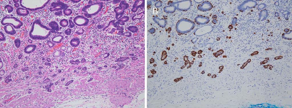 According to recent reports, gastric MA presents as an advanced tumor in most cases and is associated with a poor prognosis even when surgically treated (3).