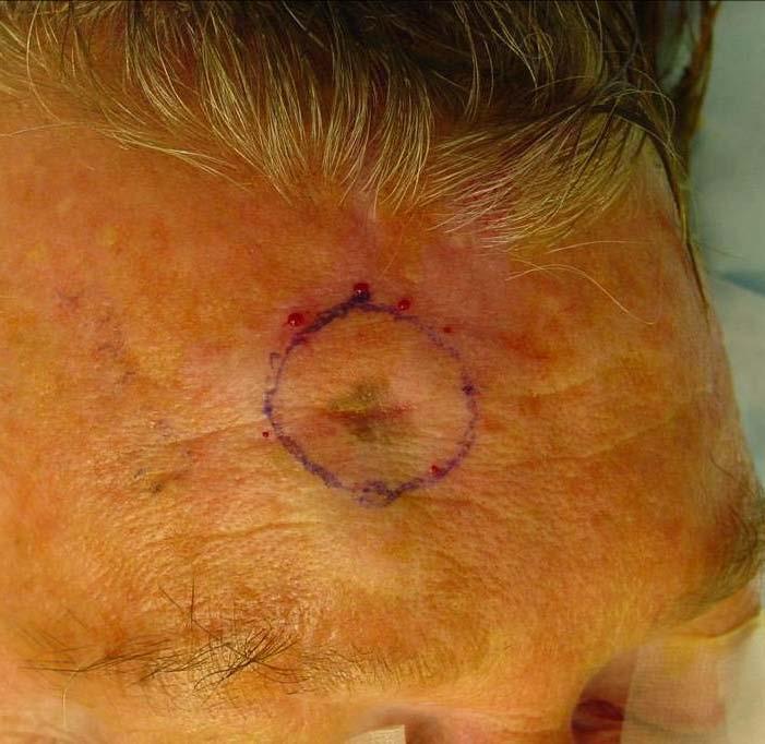 This patient had a melanoma of the forehead. A 1 cm margin is outlined. Closure of forehead defects must be done carefully so the eyebrow is not raised.