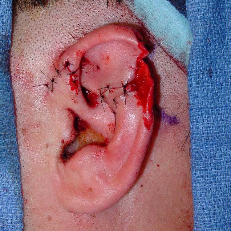 The patient lost part of his ear