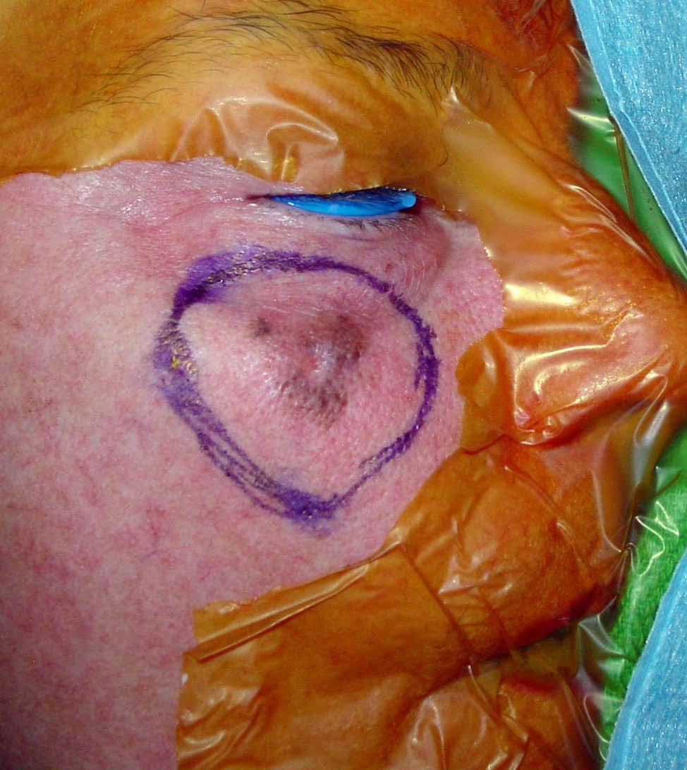 This patient had a melanoma.