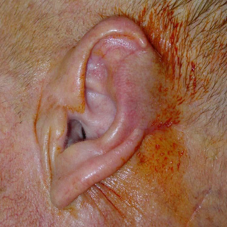 large portion of his ear