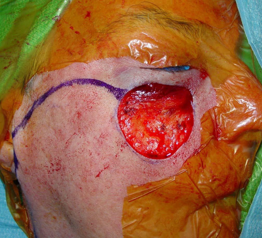 The melanoma was resected.