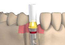 Tissue Level Single Crown Screw-retained Using the Example of RN Impression taking on implant level 2