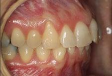 Introduction At present, there is an increasing demand for aesthetic orthodontic treatment on the part of patients.