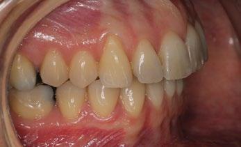 After orthodontic preparation/decompensation, 3-D