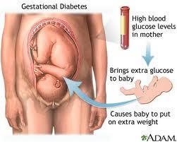 Gestational Diabetes A type of diabetes found in pregnant women Too
