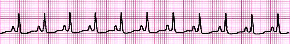 23. You arrive to find a 54-year-old female unconscious, unresponsive, pulseless and apneic. The ECG shows asystole. During the initial 2 minutes of CPR, you were able to successfully establish an IV.
