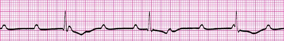 30. Your patient is a 68-year-old male who is complaining of dizziness and weakness. His EKG is below. He is restless and not oriented to place or time. His skin is pale, cool, and moist.