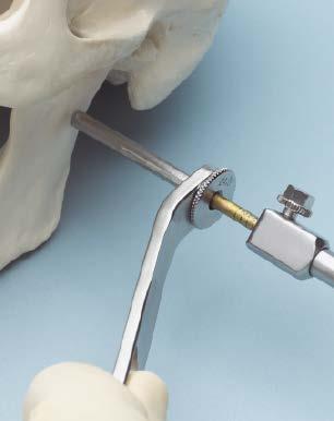 Optional Technique to Implant Schanz Screws 5 Implant Schanz screw With clockwise rotation, insert the Schanz screw