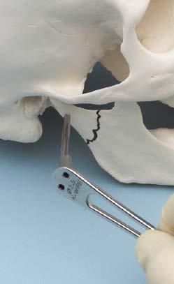 0 mm/2.5 mm Obturator Make a small stab incision at the marked site. Insert the 2.0 mm/2.5 mm obturator into the Kirschner wire drill guide and dissect through the soft tissue to the small bone fragment.