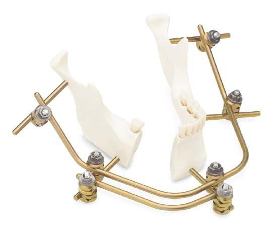 Alternative Frame Configurations Double-Stacked Frame As applied on a resected mandible. Items to build construct Quantity 03.305.006 Adjustable Clamps 7 04.305.103 4.