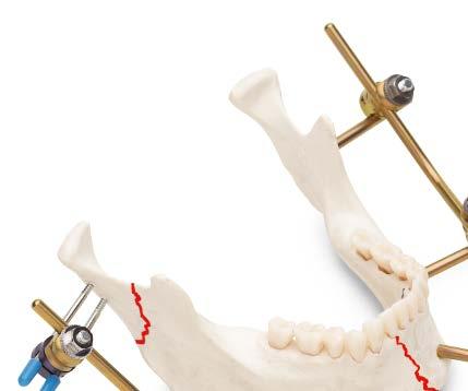 Indications The Mandible External Fixator II is intended to stabilize and
