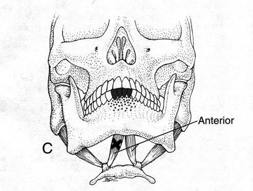 Is this pain changed with jaw movement, function or parafunction?" PLUS" Examination:" 1. Palpation of any joint site results in FAMILIAR joint pain" a. Lateral pole with fingertip applying (0.