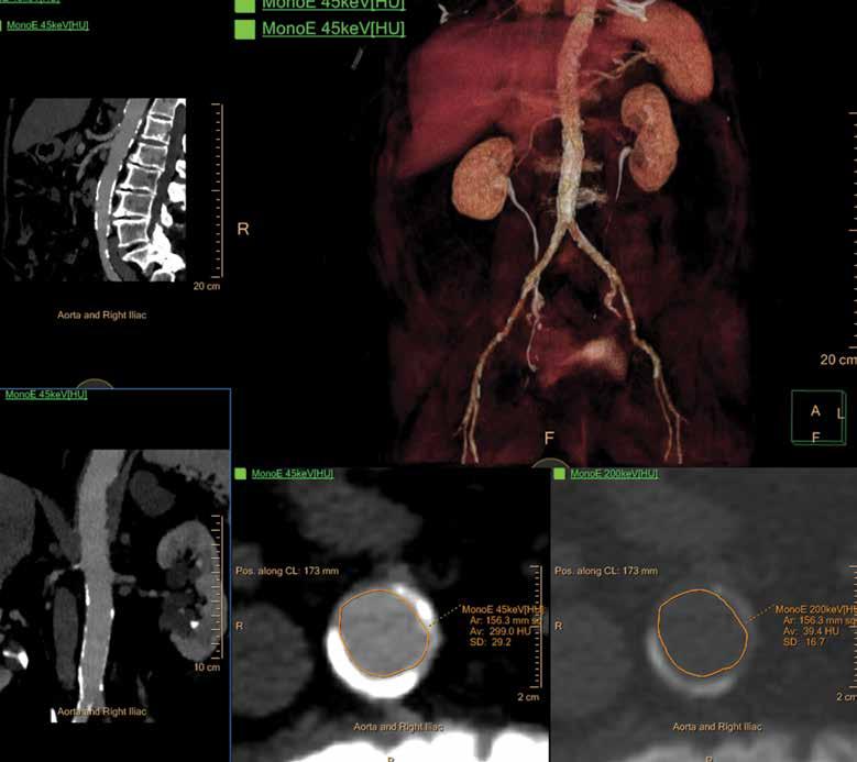 An 85-year-old patient with aortic valve stenosis and dyspnea needed scans for a pre-procedural evaluation.