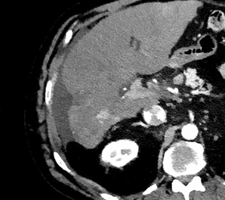 This patient, who was previously diagnosed with hepatic cell carcinoma and liver cirrhosis, underwent ablation to treat the hepatic lesions. Ablation effectiveness following treatment was a concern.