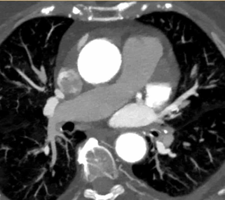 A 53-year-old patient was being evaluated for pulmonary venous anatomy prior to radiofrequency ablation for atrial fibrillation and was referred to CT following an abnormal Transesophageal