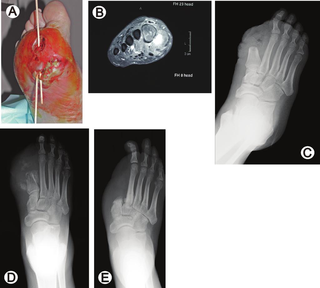 Figure 10 (A) This diabetic foot infection is quite severe, with necrotic skin defects and soft tissue sinus formation.