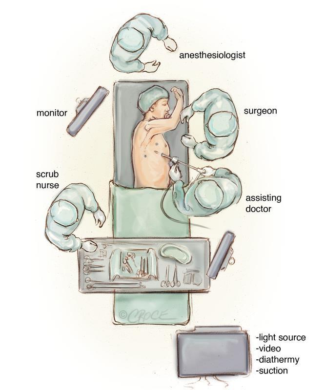 VATS Microlobectomy