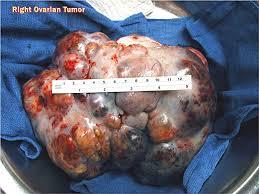 PERITONEAL SPREAD can present with : - enlarged ovary