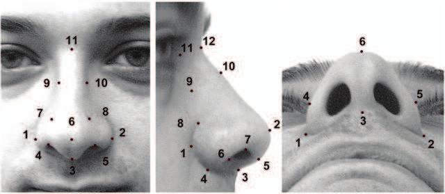 Anthropometric Analysis of the Nose 5 * 1: the junction of nasolabial crease and nasal blade (ala nasi) 2: prn, Pronasale, the most prominent point on the nasal tip 3: sn, Subnasale, the midpoint of