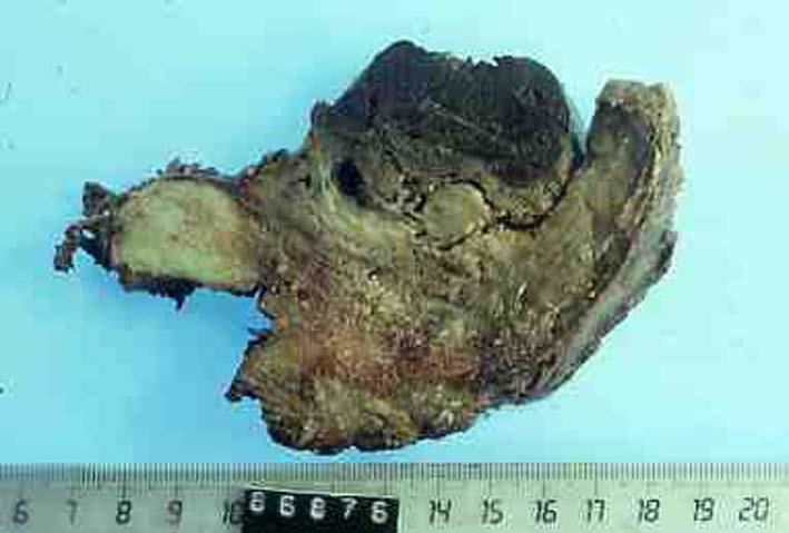 complete resection of Pancoast tumors with involvement of