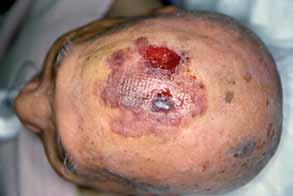 # Cutaneous angiosarcoma of the scalp and face # TABLE 3.