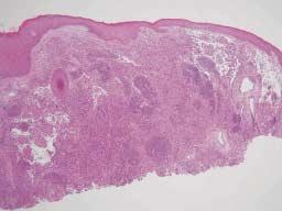 Cutaneous angiosarcoma 211 Figure 2.