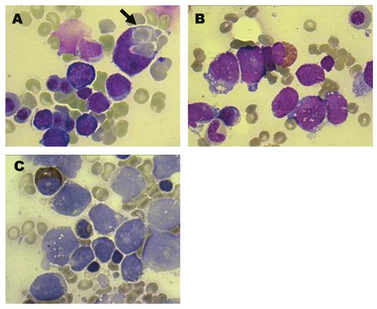 2 Figure 1. Morphology of leukemic cells at diagnosis (1000 ).