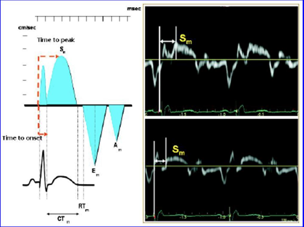 Methodology for measuring pulsed Tissue Doppler derived time to peak 5m and time to onset 5m (left panel).