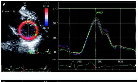 Speckle tracking imaging demonstrating synchrony of peak segmental radial