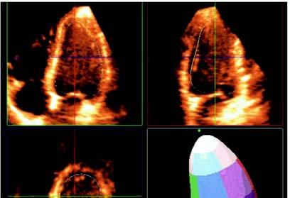 Three dimensional echocardiographic assessment of