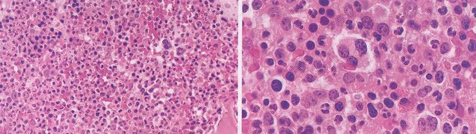 JMML: BM Morphology Hypercellular bone marrow with granulocyte proliferation.