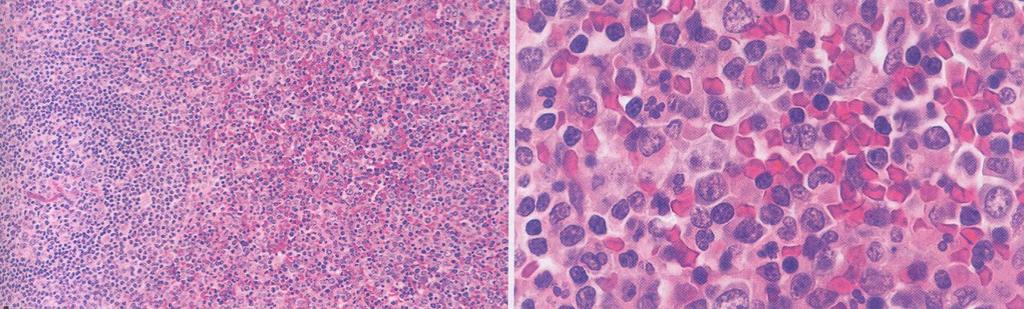 JMML Spleen: leukemic infiltrate in red pulp region of spleen spares the