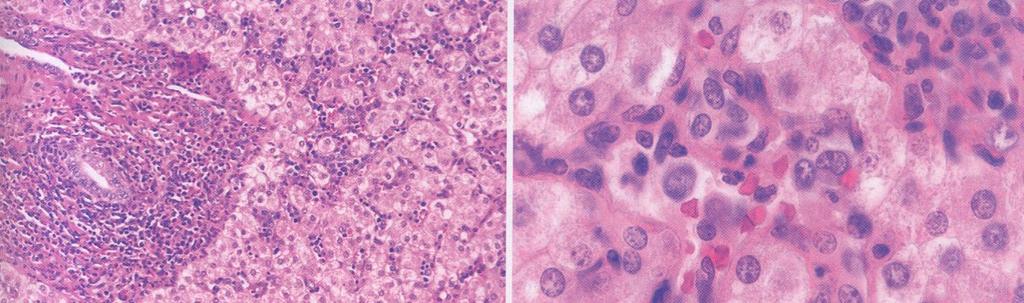 JMML Liver: leukemic infiltrate in the