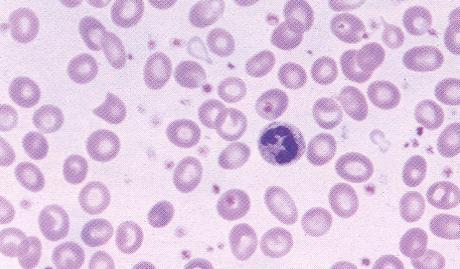RARS associated with marked thrombocytosis Marked