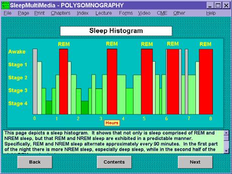 REM Sleep In REM sleep, there is paralysis or nearly absent muscle tone (except the control of one s breathing) There is increased levels of brain activity Dreaming occurs during the REM portion of