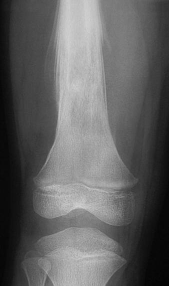 Fig. 6 6-year-old girl with Ewing s sarcoma., Radiograph shows aggressive lesion of distal femur.