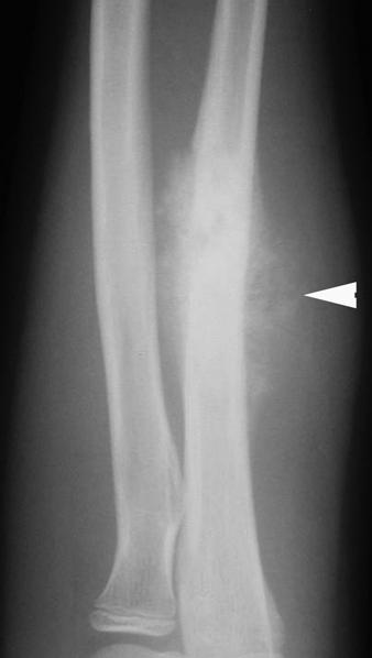 C Fig. 10 11-year-old girl with metastatic osteosarcoma., Forearm radiograph shows osteosarcoma of ulnar diaphysis (arrowhead).