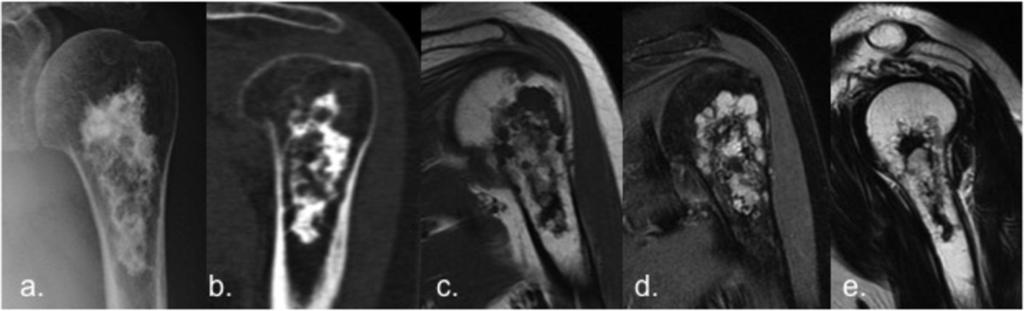 Fig. 2: Enchondroma of the humerus in a 66 year-old woman. (a,b).
