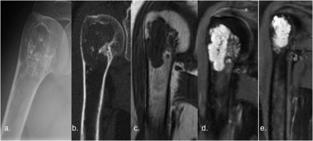 (a,b) Anteroposterior radiograph shows a central area of punctate calcifications with scattered punctate foci of cartilage matrix.