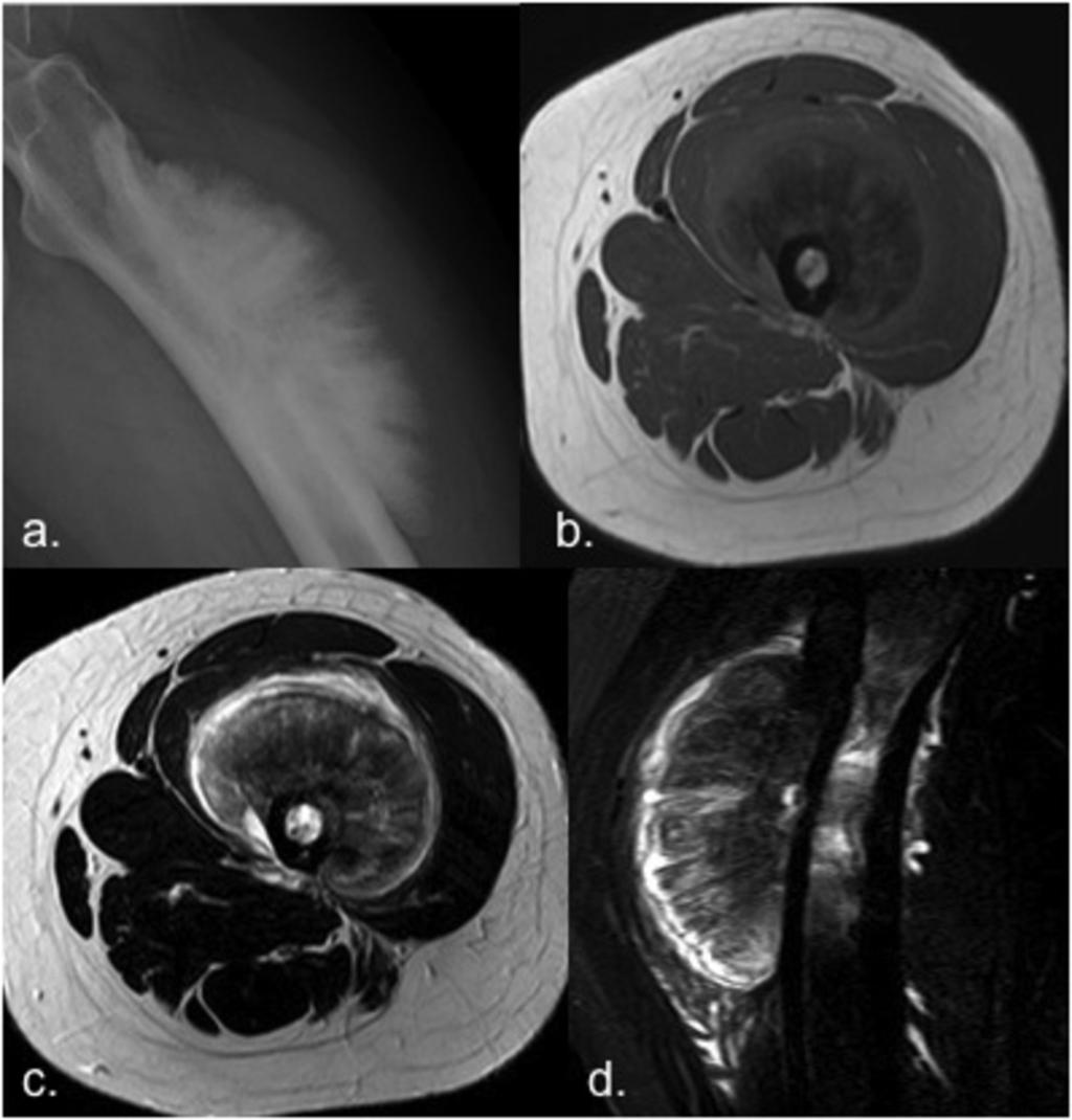 Fig. 6: Osteosarcoma of the femur in a 29 year-old man. (a) Radiograph shows a lesion with aggressive hair-on-end periosteal reaction and soft-tissue mass.
