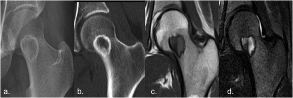 Fig. 7: Osteoblastoma of the femoral neck in a 24 years-old woman.