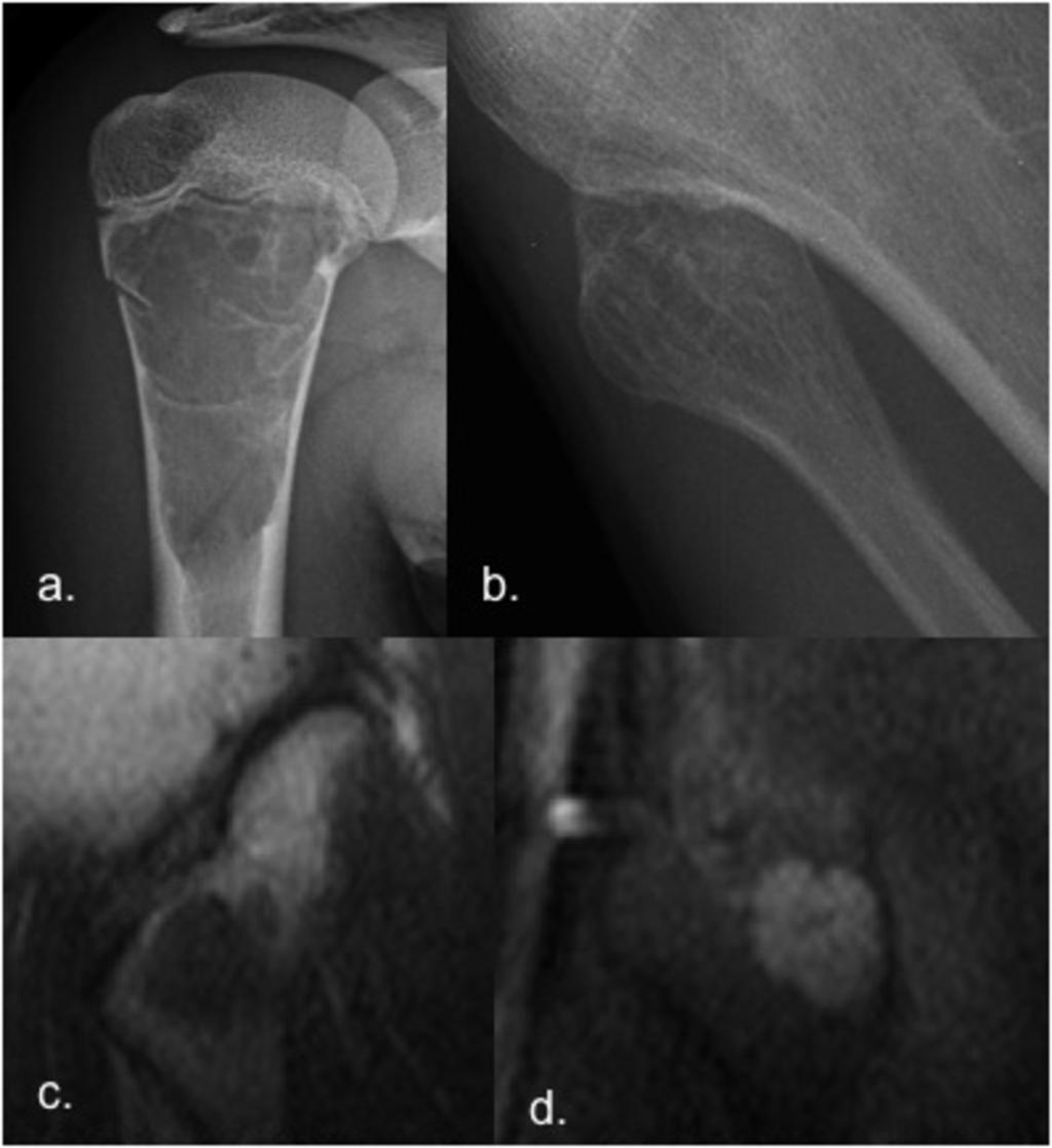 Fig. 8: Simple bone cyst of humerus in a 13 year-old girl.