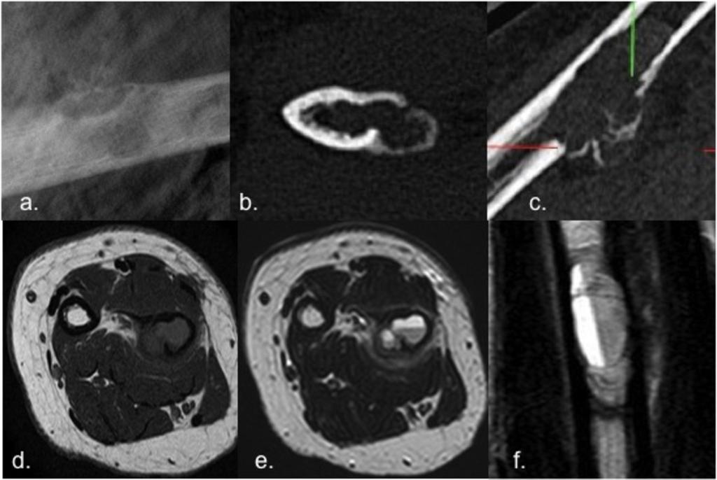 Fig. 9: Aneurysmal bone cyst of radius in a 57 years-old woman.