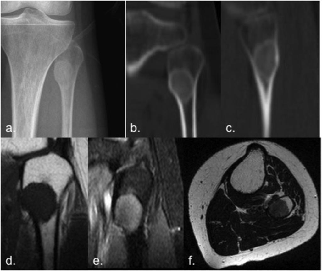 Fig. 10: Fibrous dysplasia of fibula in a 25 years-old woman.