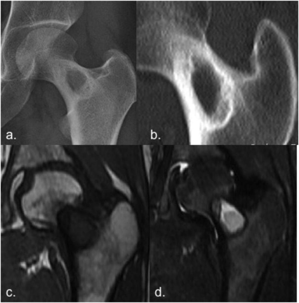 Fig. 11: Non-ossifying fibroma of femoral neck in a 31 year-old woman.