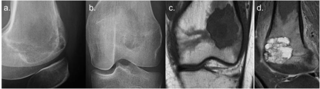 Fig. 12: Giant cell tumour of distal femur in a 24 years-old woman. (a, b) Lateral and anteroposterior radiograph show a geographic eccentric lytic lesion, well defined and nonsclerotic margins.