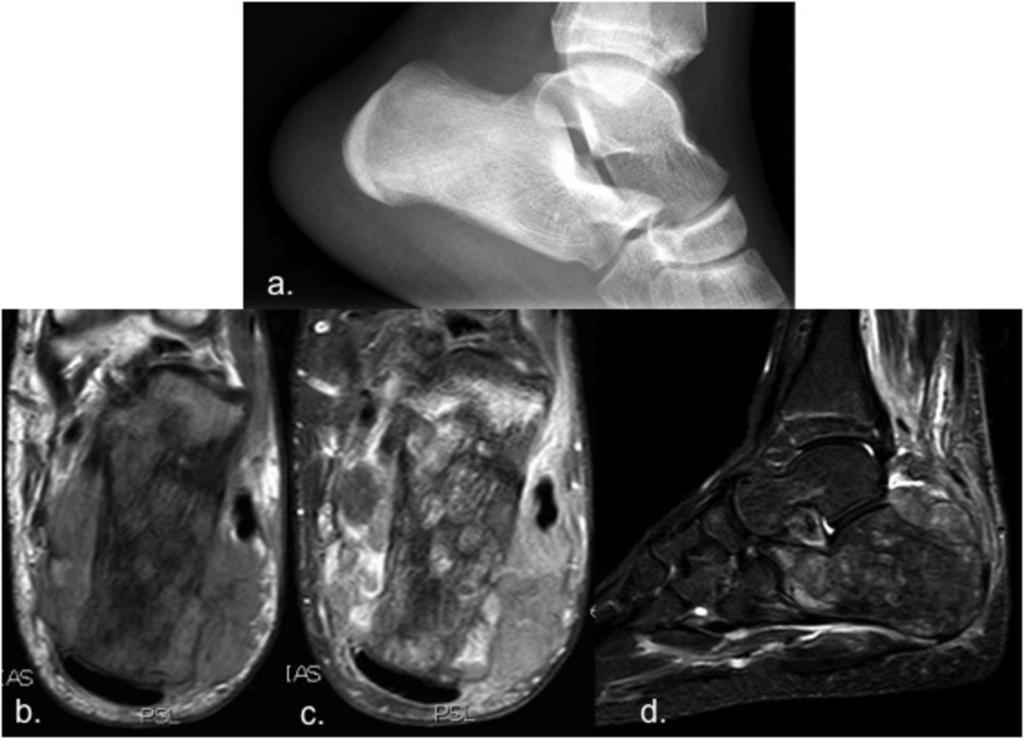 (c, d) Coronal low signal intensity on T1-WI and High intensity on DPFS-WI MR images, demostrates a well defined lesion with extension into the epiphysis and adjacent bone oedema. Fig.