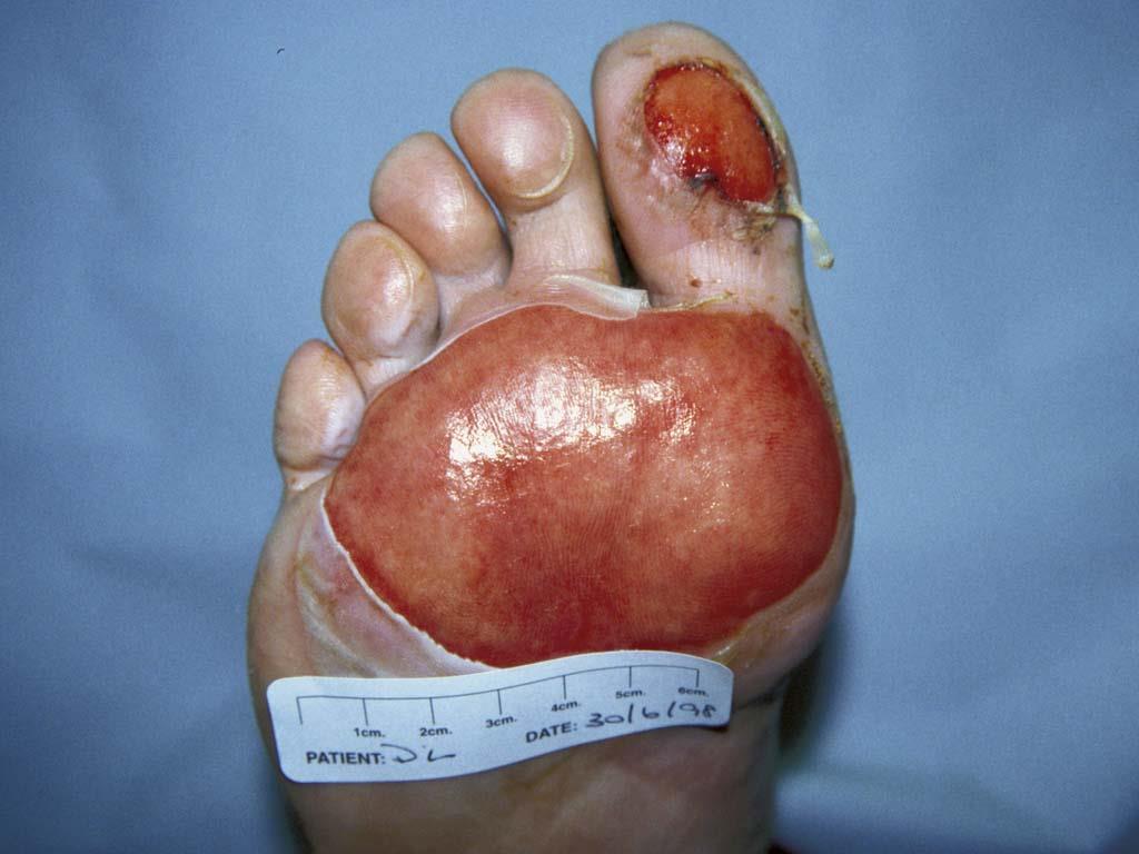 Do not walk barefoot Burn to sole