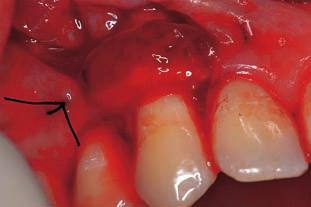 Procena stawa parodontnih tkiva, obima i tipa recesije izvedena je utvrđivawem vertikalne dimenzije recesije (VDR), širine keratinizovane gingive, nivoa pripojnog epitela i gingivnog indeksa po Lou